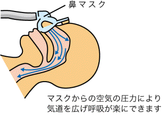 ＣＰＡＰ